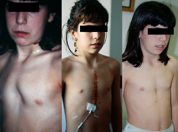 Pectus Excavatum.