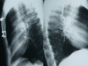 Condromanubrial form improved with metal fixture